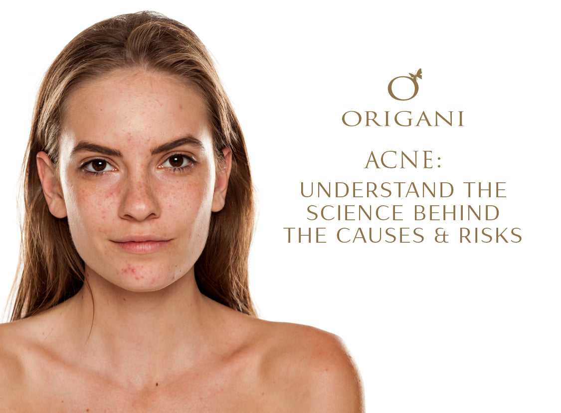 Acne: Understand The Science Behind The Causes And Risks