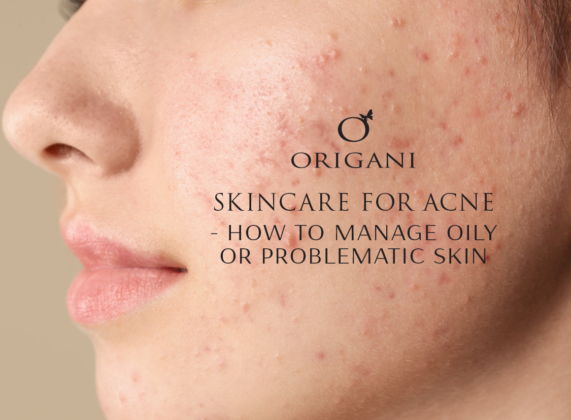 Skincare For Acne - How To Manage Oily Or Problematic Skin